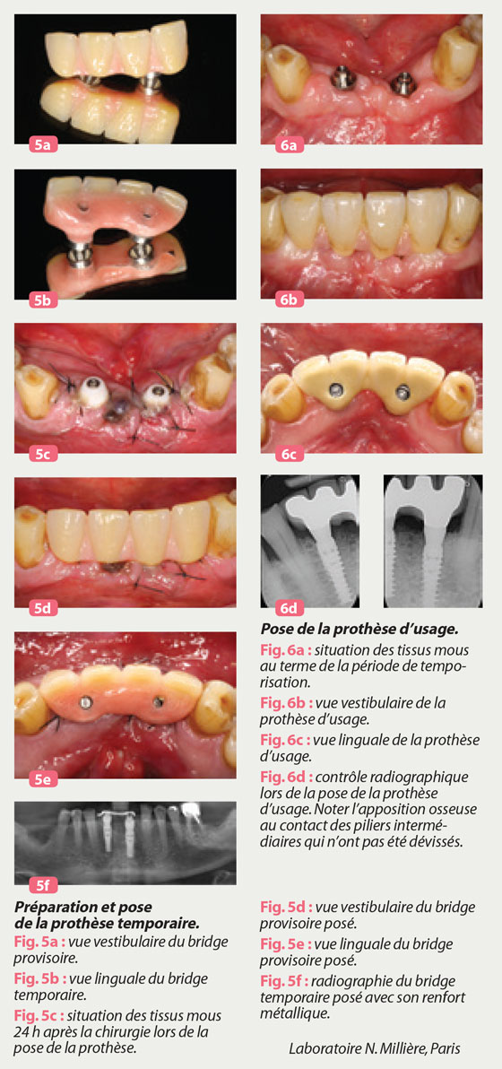 Extraction implantation et temporisation immédiate sur les dents unitaires  antérieures : 10 ans de recul clinique