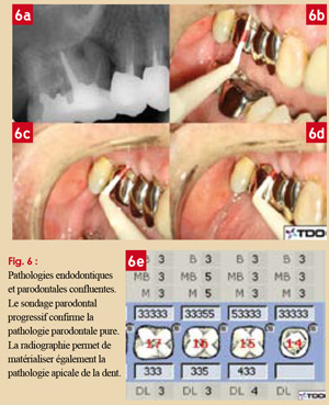 Pathologies-endodontiques