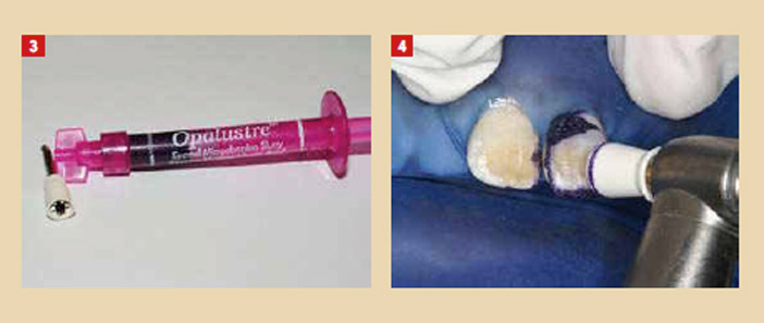 La digue dentaire - ResiDentaire™  Plateforme de QCM Médecine Dentaire