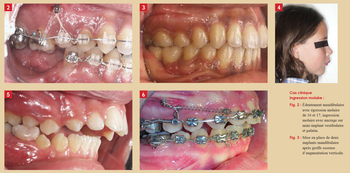 Mini-implants ou mini-vis pour l'orthodontie