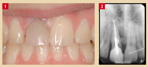 fin-traitement-orthodontique