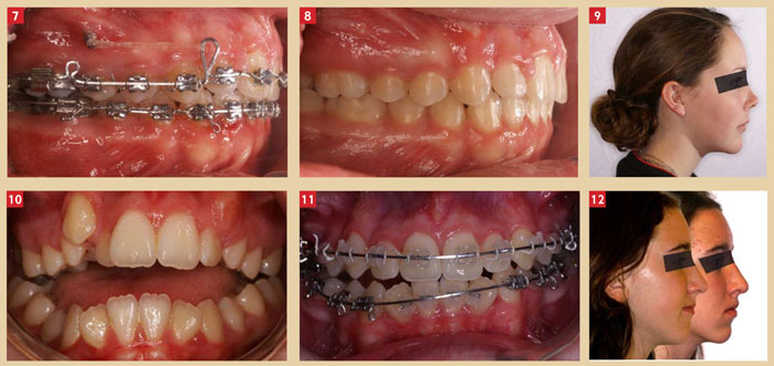 photo-apres-ingression-orthodontique