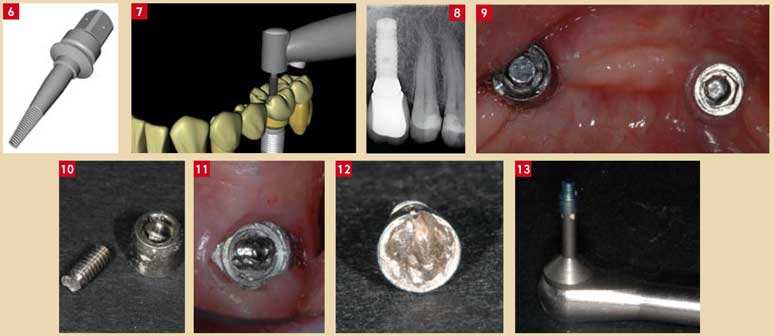 Comment éviter les excès de ciment/colle en prothèse scellée sur piliers  implantaires #2 - L'édenté total
