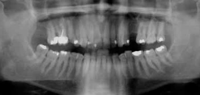 Imagerie cone beam ou tomographie volumique à faisceau conique