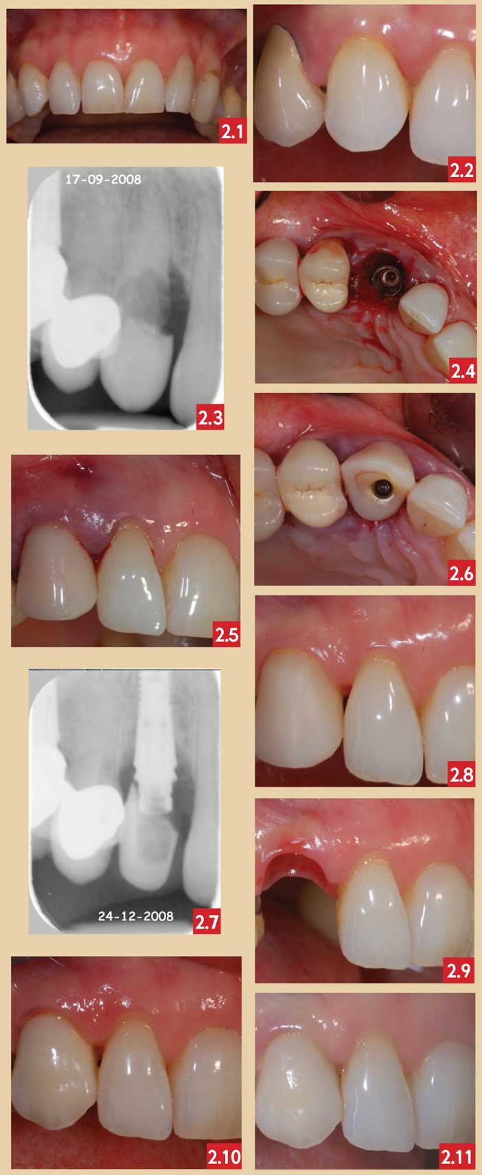 Extraction implantation et provisoire immédiates