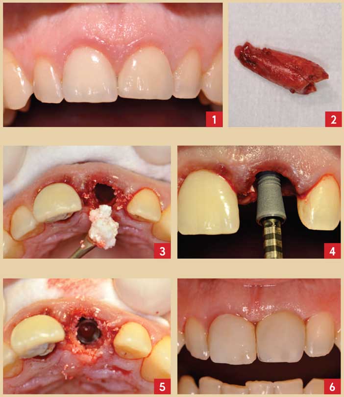 Extraction implantation et temporisation immédiate sur les dents unitaires  antérieures : 10 ans de recul clinique