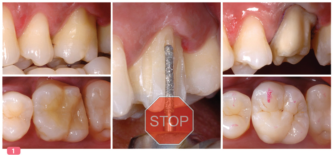 Matériel dentaire résine composite à polymérisation légère Kit de
