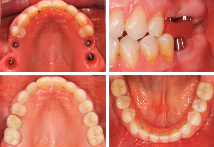 Utilisation des mini-implants d'ancrage en orthodontie pré-prothétique  sectorielle