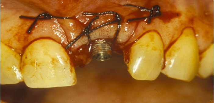 Extraction implantation et temporisation immédiate sur les dents unitaires  antérieures : 10 ans de recul clinique