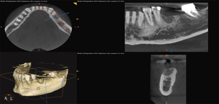 Comment Choisir Un Cone Beam - 