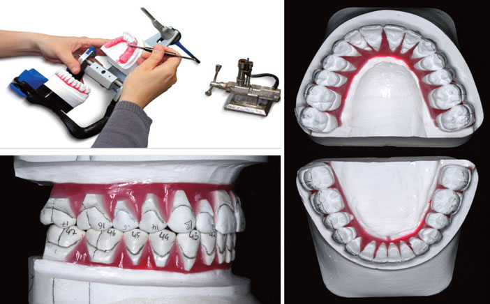 Le set-up numérique la révolution de l'orthodontie digitale