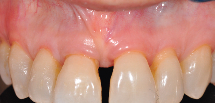 Extraction implantation et temporisation immédiate sur les dents unitaires  antérieures : 10 ans de recul clinique