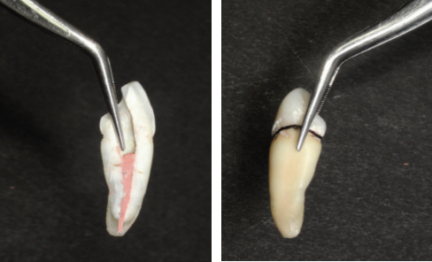 Technique d'éclaircissement sur dents dépulpées