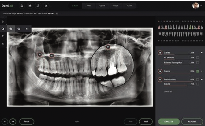 Vers l'utilisation de protège-dents intelligents détectant les commotions  ?