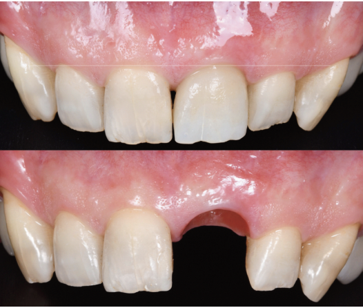 Extraction implantation et temporisation immédiate sur les dents unitaires  antérieures : 10 ans de recul clinique