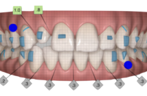 orthodontiste_marseille - Pose de mini vis d'ancrage lorsqu'il n'est pas  possible de s'appuyer sur les dents trop fragiles chez l'adulte . Ce  patient est en cours de préparation orthodontique en vue d'une